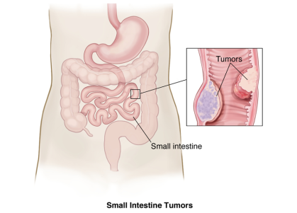 Small Intestine Tumors